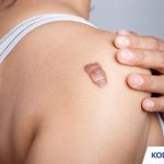 Besaran Biaya Operasi Keloid