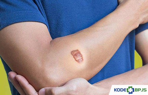 Penyebab Keloid Tumbuh Lebih Besar