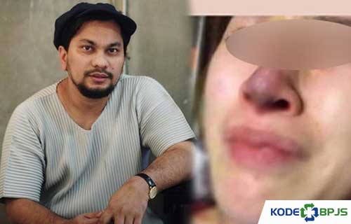 Biaya Operasi Hidung Dr Tompi Terbaru dan Tips Bermanfaat