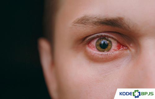 Kode BPJS atau ICD 10 Konjungtivitis