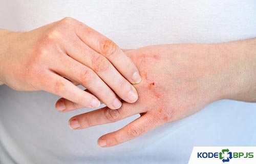 Icd 10 dermatitis kontak alergi