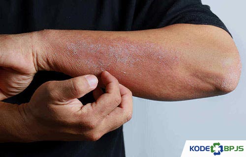 Kode ICD 10 Dermatitis