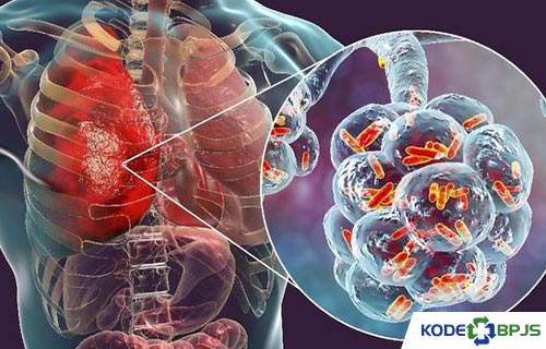 Kode Icd 10 Pneumonia 2021 Penyebab Gejala Pengobatan