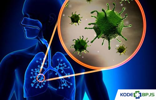 Penyebab Pneumonia