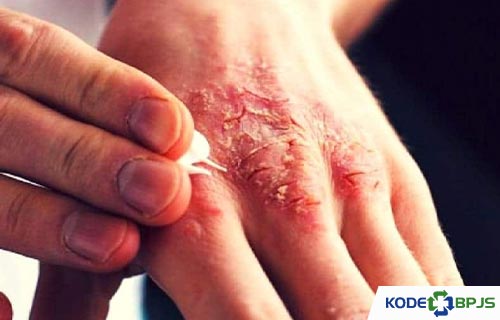 Kode ICD 10 Scabies Kudis Penyebab Gejala Pengobatan