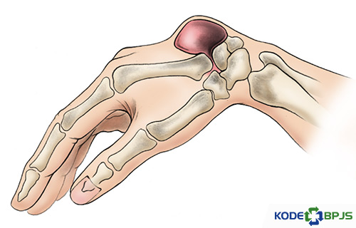 Apa Itu Ganglion