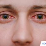 Kode ICD 10 Keratitis Penyebab Gejala Pengobatan