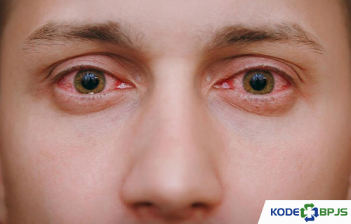 Kode Icd 10 Keratitis 2021 Penyebab Gejala Pengobatan Kodebpjs