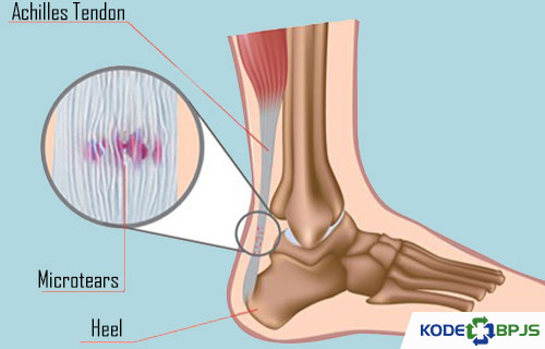 Apa Itu Kode ICD 10 Ruptur Tendon