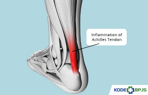 Diagnosis Ruptur Tendon