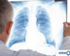 Kode ICD 10 Bronkopneumonia Penyebab Cara Mengobati