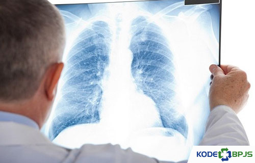 Kode ICD 10 Bronkopneumonia Penyebab Cara Mengobati