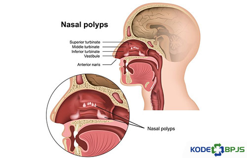 Kode ICD 10 Polip Nasal