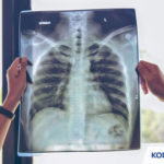 Kode ICD 10 TB Paru Penyebab Gejala Pengobatan