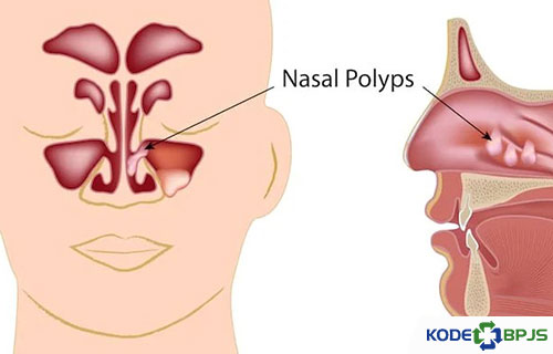 Penyebab Penyakit Polip Nasal