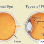 Kode ICD 10 Floaters Penyebab, Gejala & Cara Mengobati