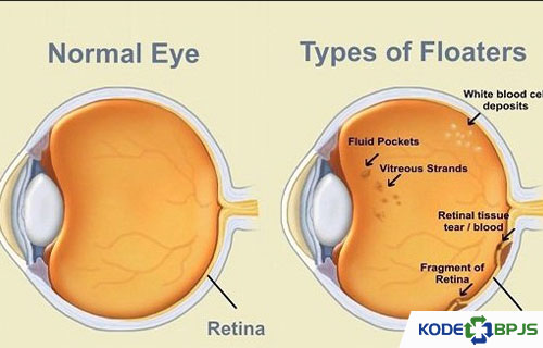 Kode ICD 10 Floaters Penyebab, Gejala & Cara Mengobati