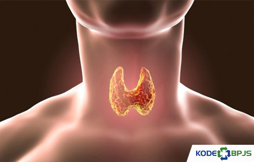 Kode ICD 10 Hipertiroid Penyebab Gejala Cara Mengobati