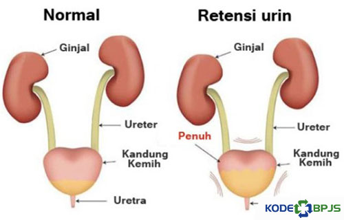 Apa Itu Retense Urine