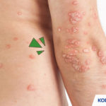 Kode ICD 10 Neurodermatitis