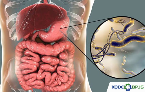 Penyebab Ulkus Peptikum