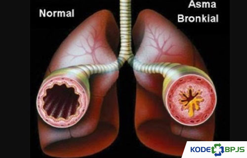 Apa Itu Asma Bronkial