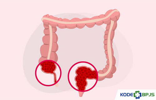 Apa Itu Colitis