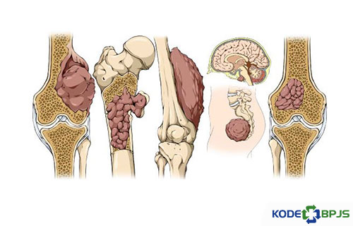 Apa Itu Penyakit Osteoma