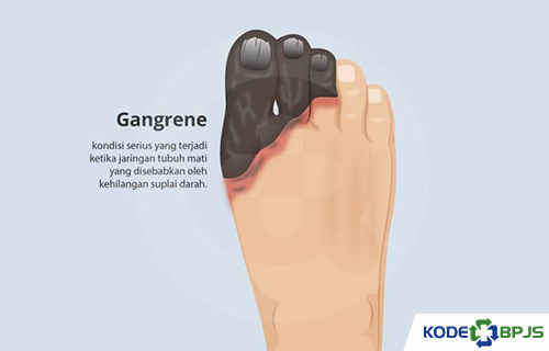 Penyebab Gangren Pedis