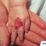 Kode ICD 10 Hemangioma