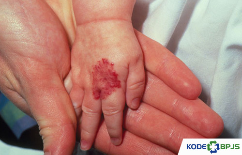 Kode ICD 10 Hemangioma