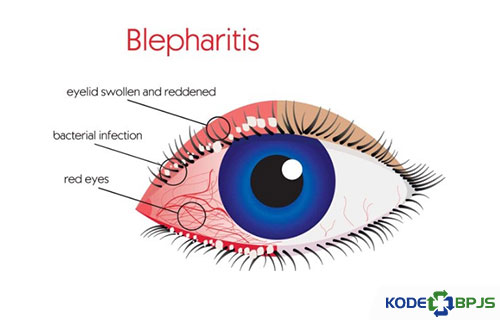 Apa Itu Penyakit Blepharitis